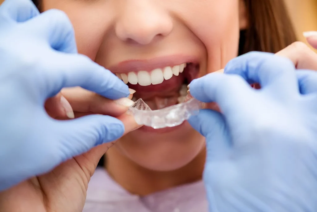 Invisible braces in aurangabad